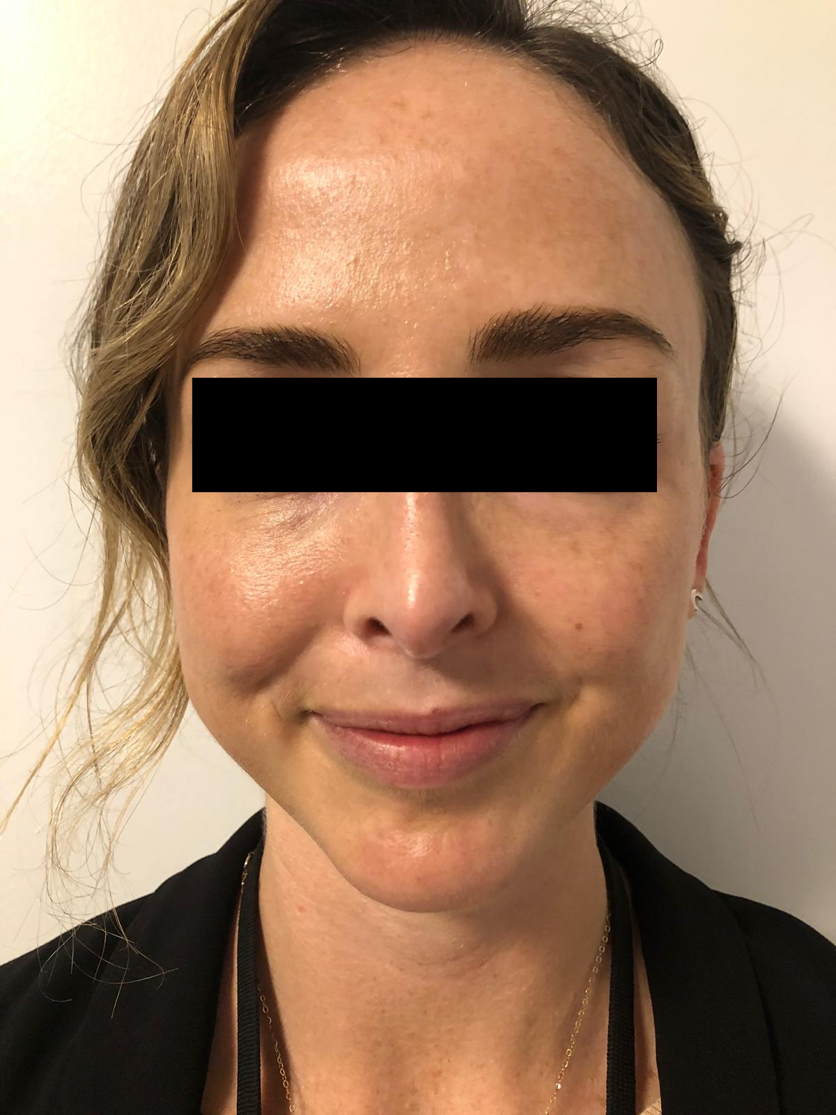 Client 1 after PRP Microneedling, 1 week apart