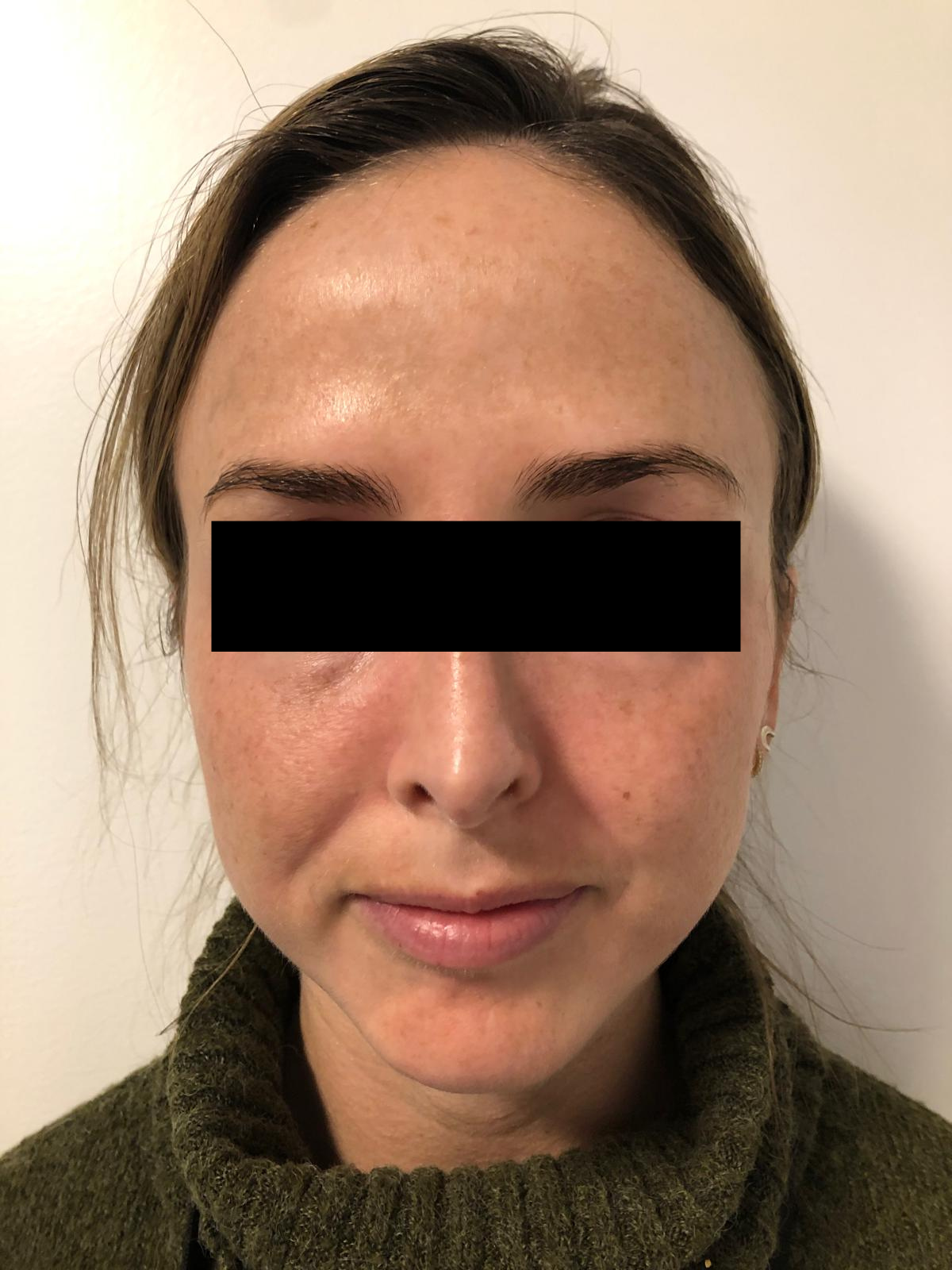 Client 1 before PRP Microneedling, 1 week apart