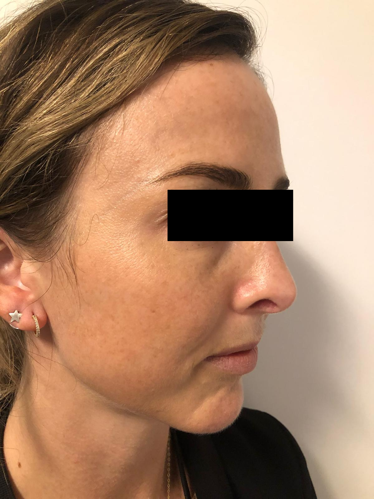 Client 1 after PRP Microneedling, second result, 1 week apart