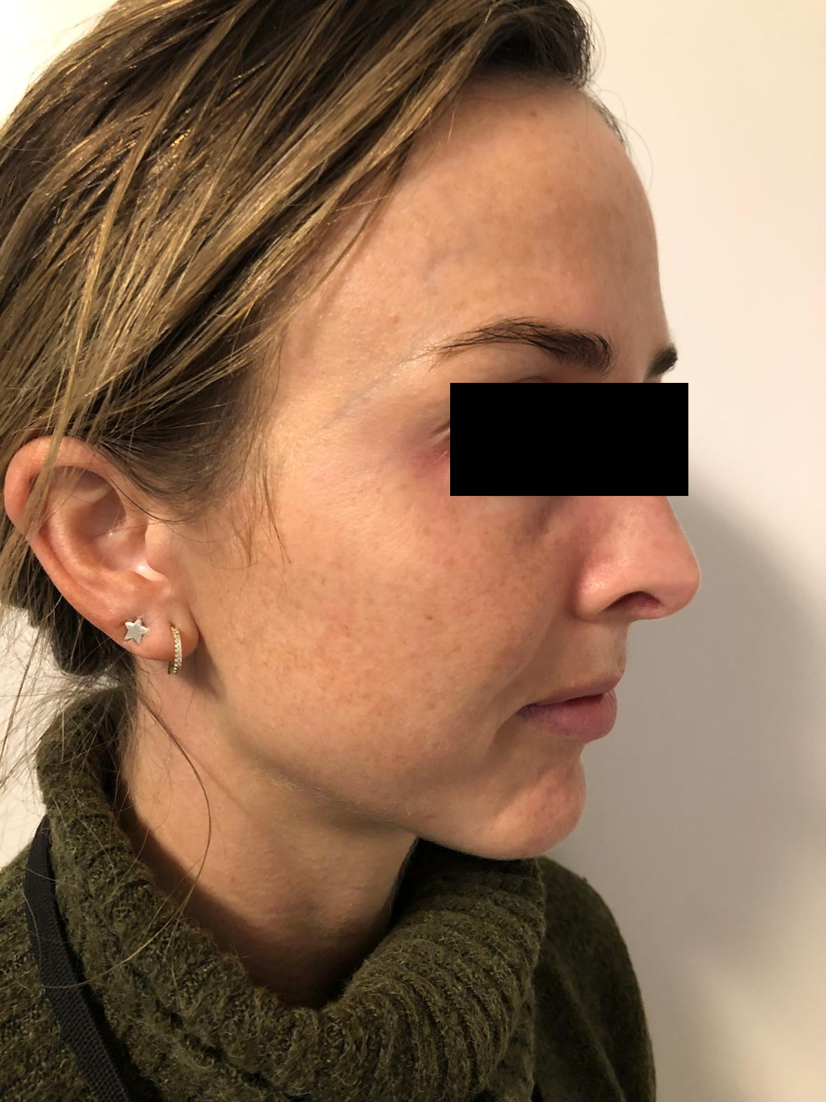 Client 1 before PRP Microneedling, second result, 1 week apart