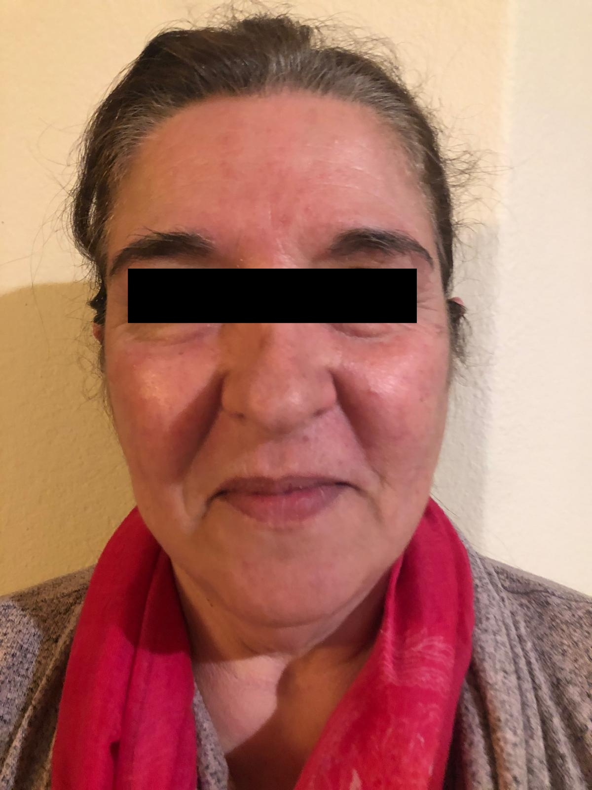 Client 2 after PRP Microneedling for rosacea and redness, 1 month apart