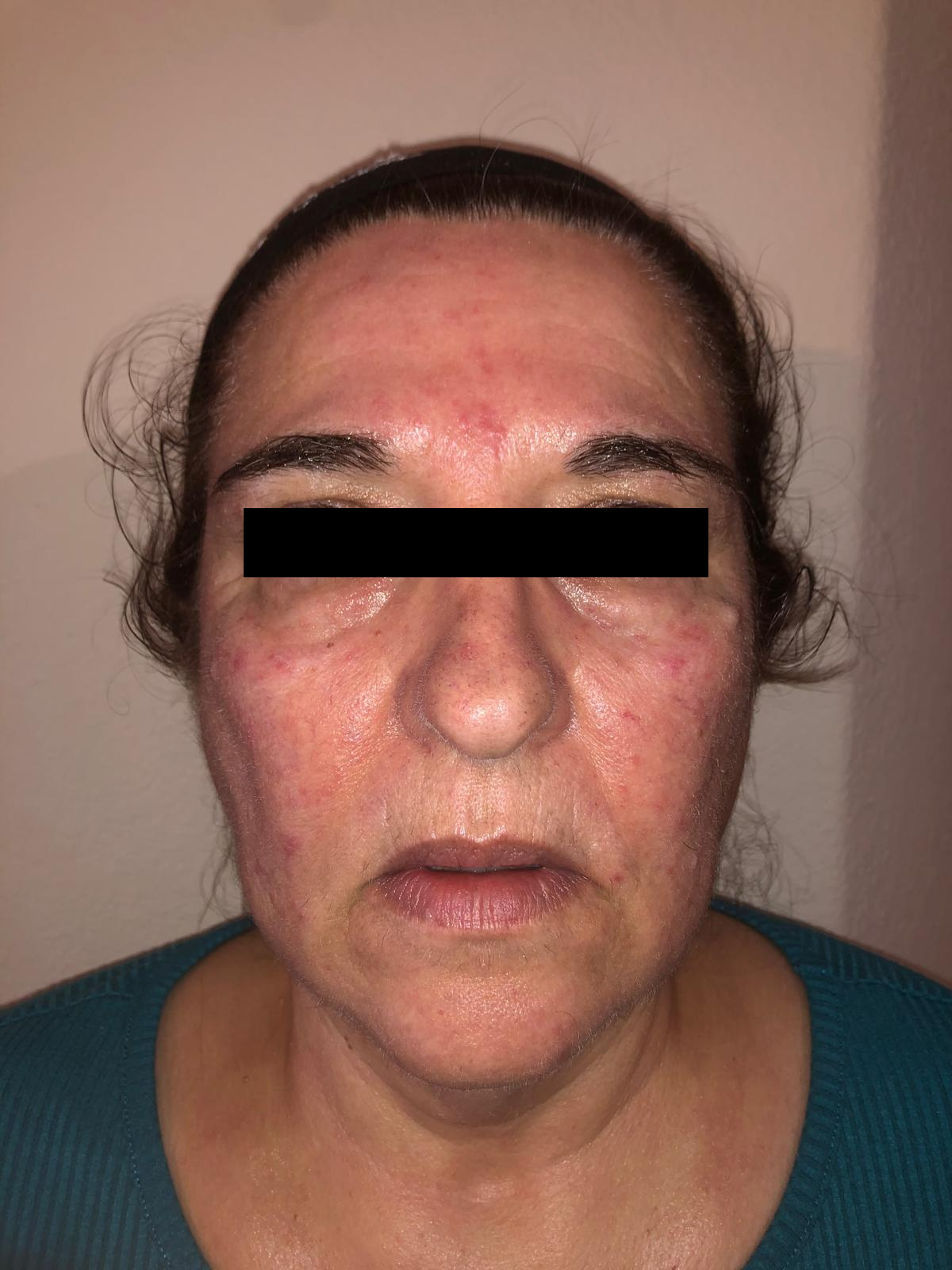 Client 2 before PRP Microneedling for rosacea and redness, 1 month apart