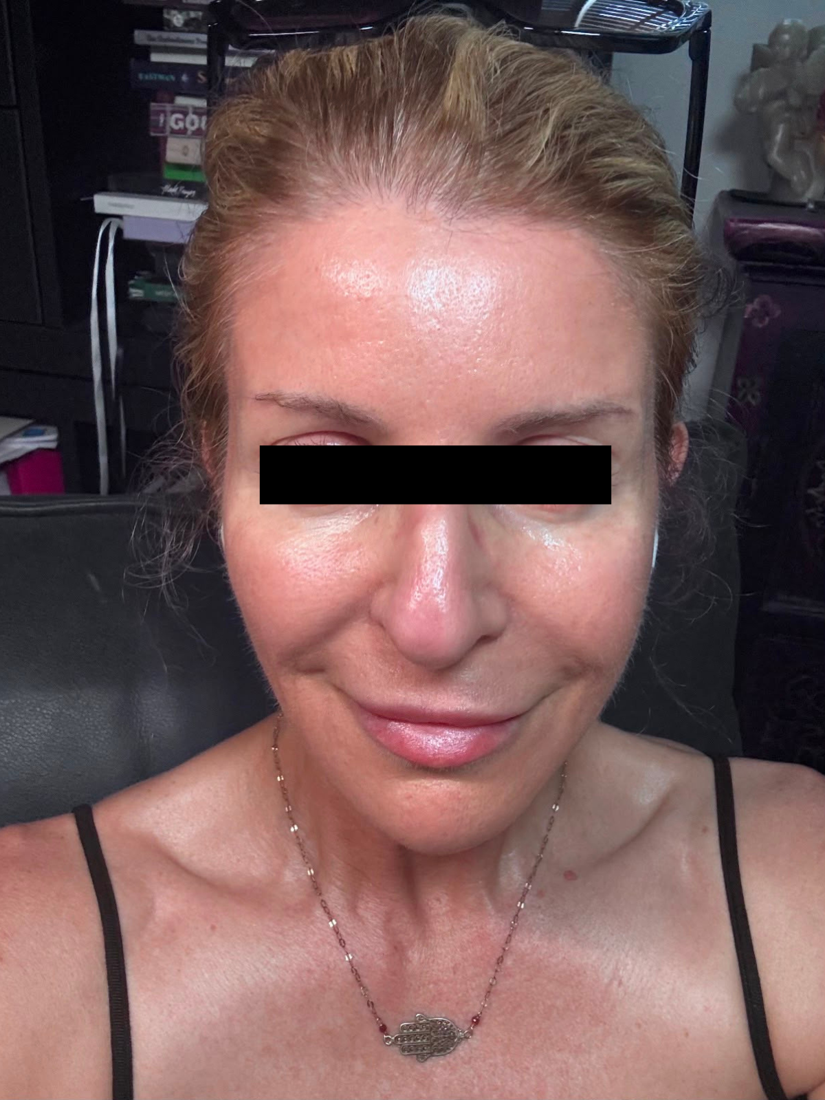 Client 3 after PRP Microneedling