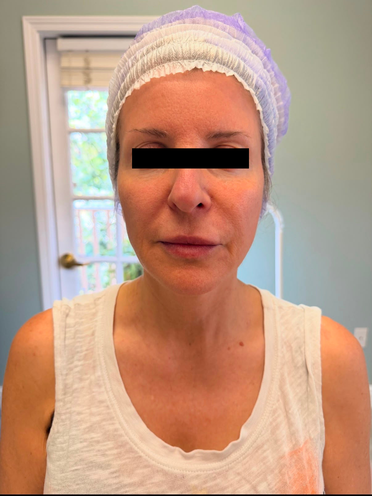 Client 3 before PRP Microneedling