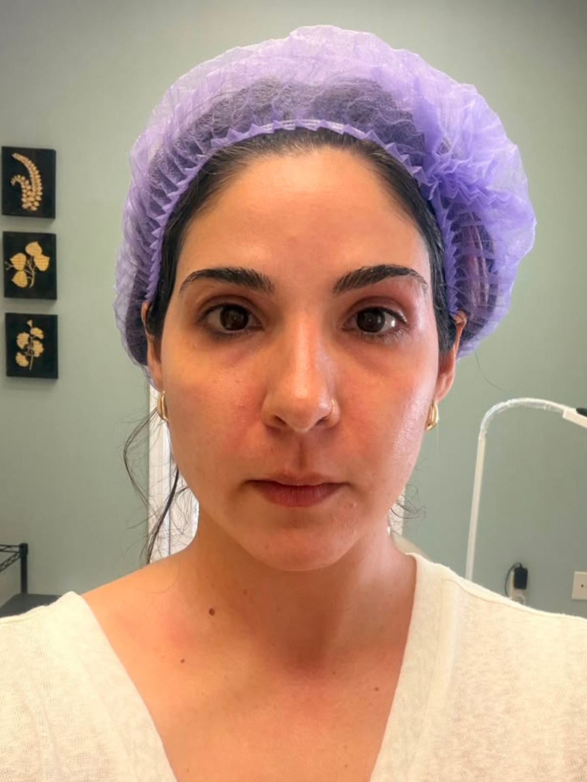 Dr. La Rocca before PRP Microneedling